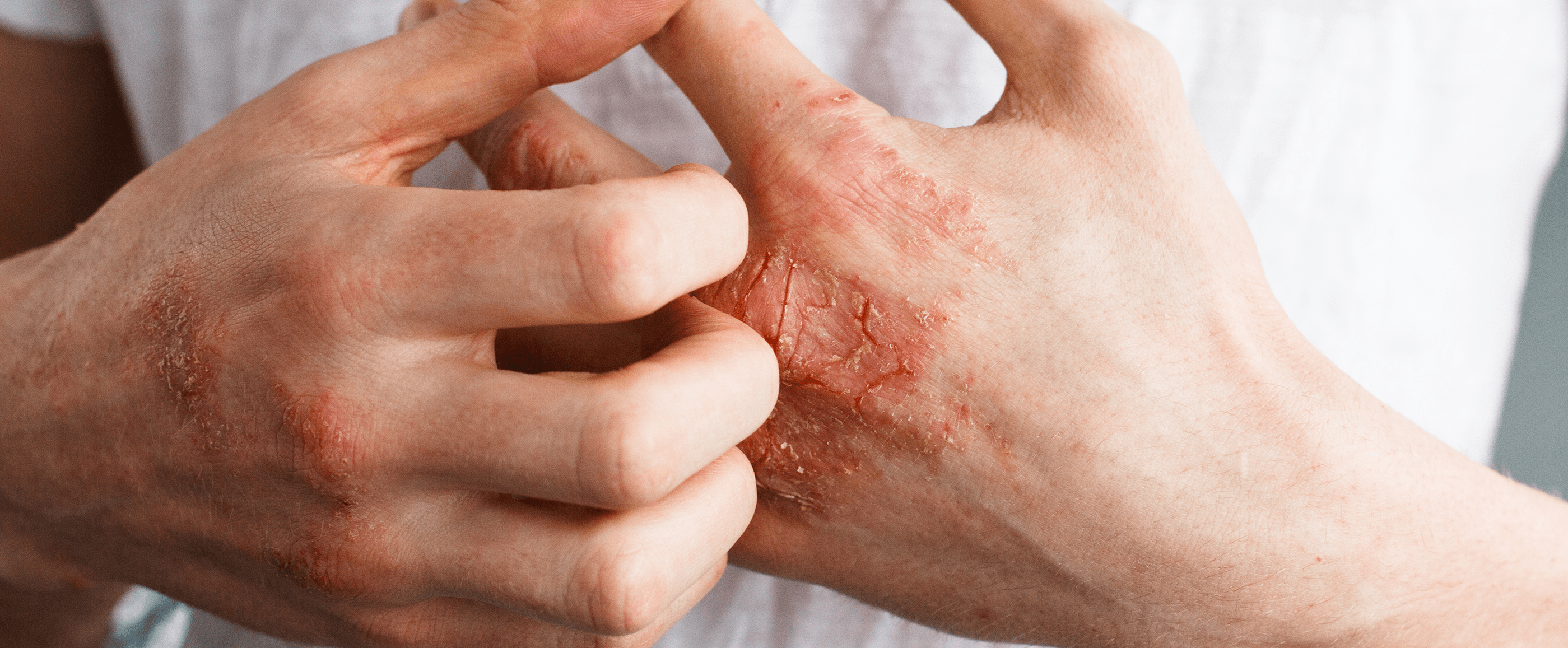 eczema-types-symptoms-and-treatment-eucerin